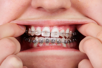 What to Know About Braces, Invisalign & Retainers - SOLDENTAL