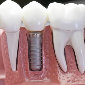 dental_implants