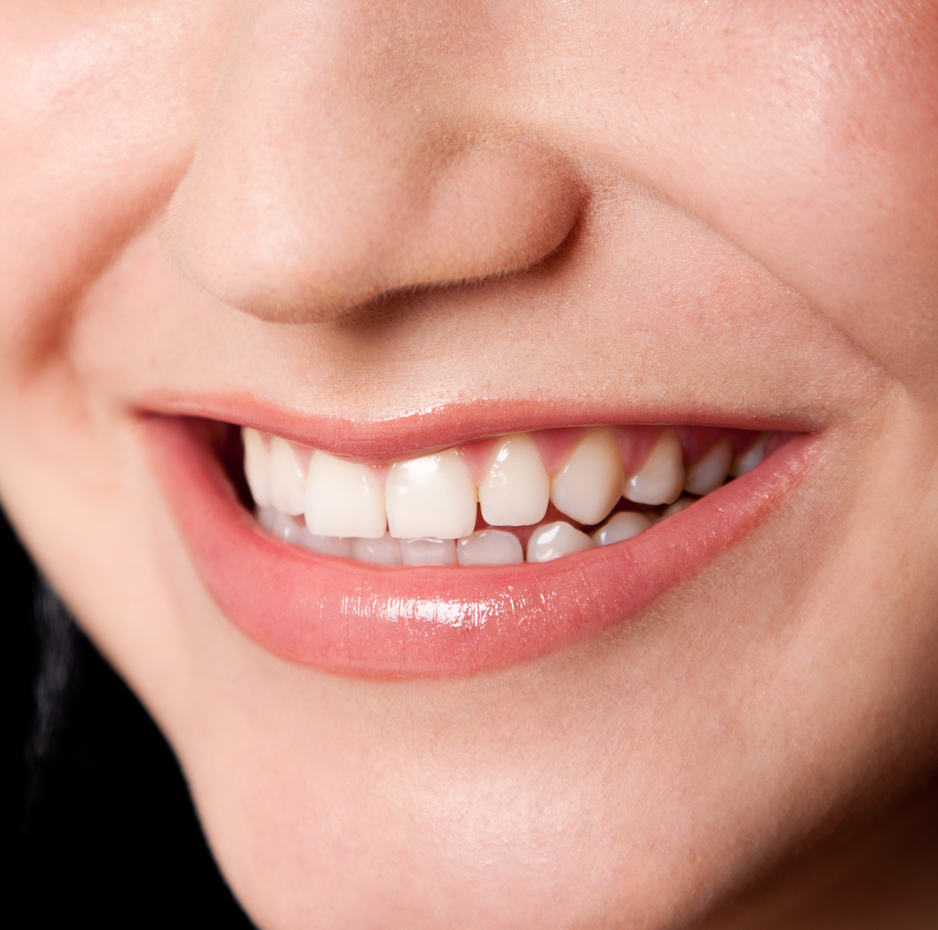 The Pros And Cons Of Veneers